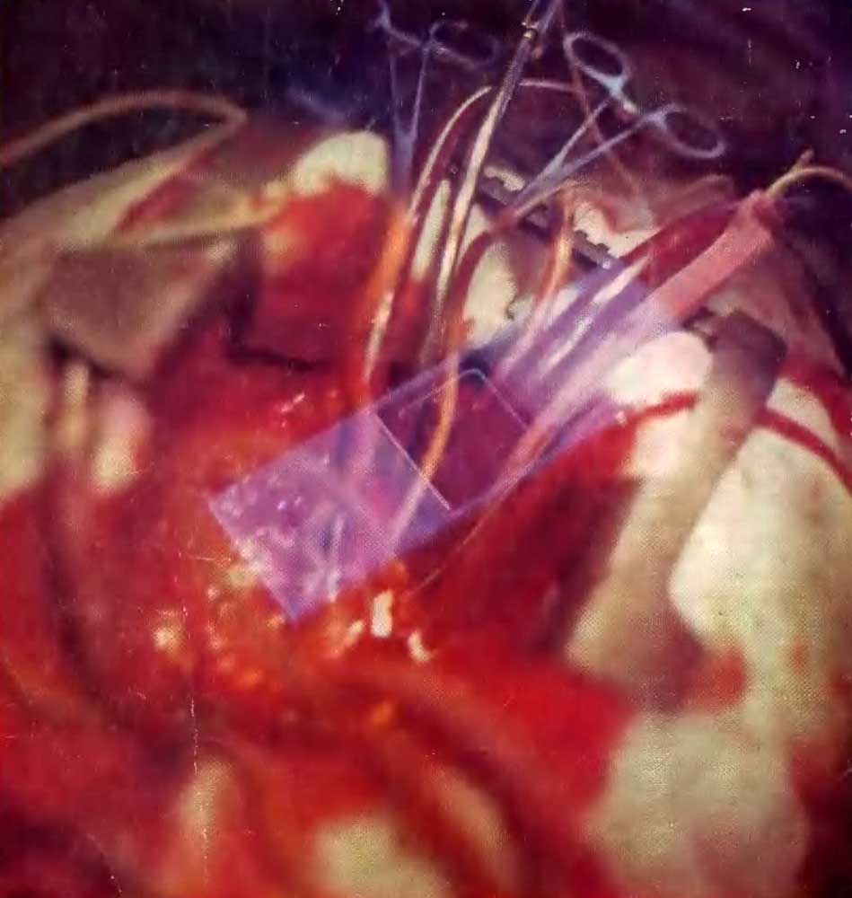 Вживление процессора в сердце человека - кардиохирургия