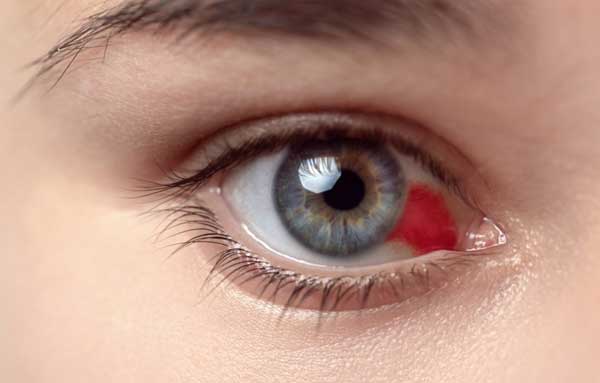 Лечение гемофтальма