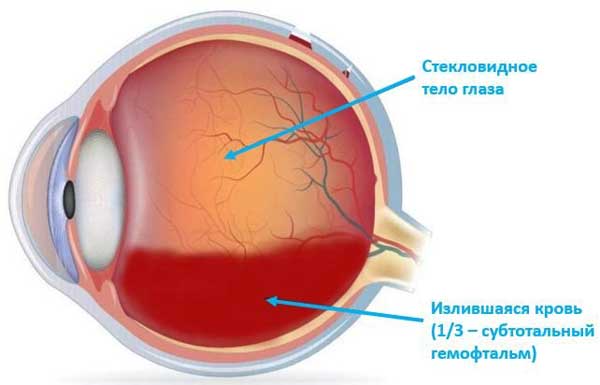 Гемофтальм