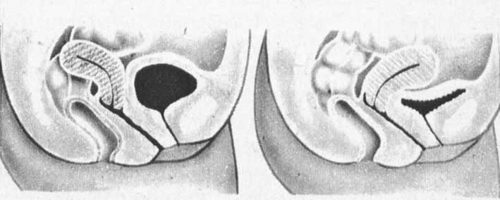 Загиб матки - отчего и возможна ли беременность?