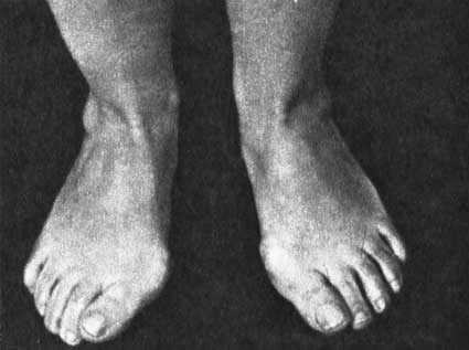 заболевание ног при поперечном плоскостопии