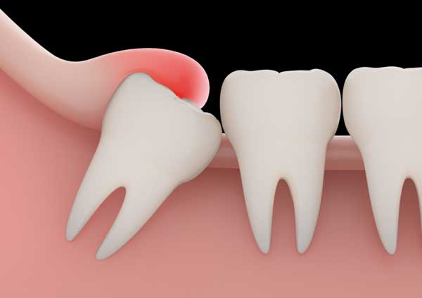 зуб мудрости