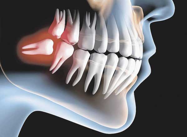 зуб мудрости