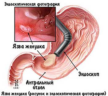 Гастродуоденоскопия - что это, как делается, сколько стоит, как готовиться?